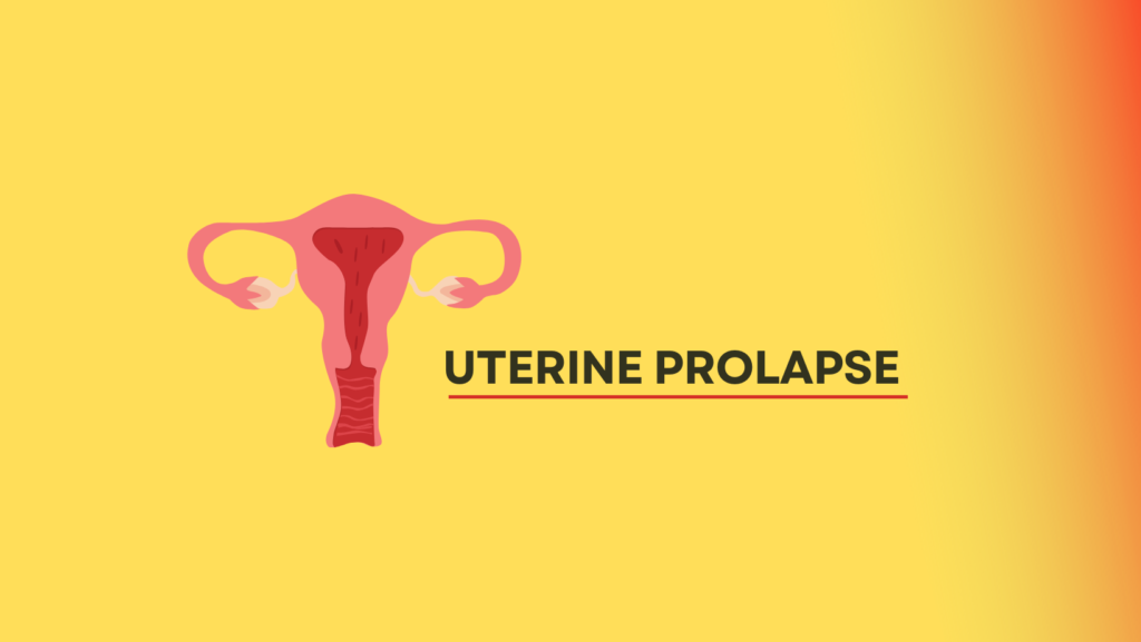 Uterine Prolapse.