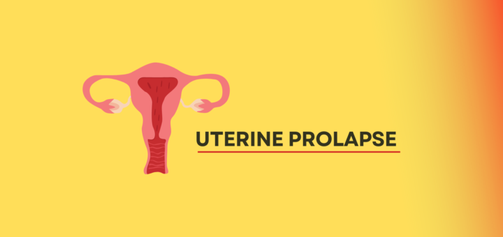 Uterine Prolapse.