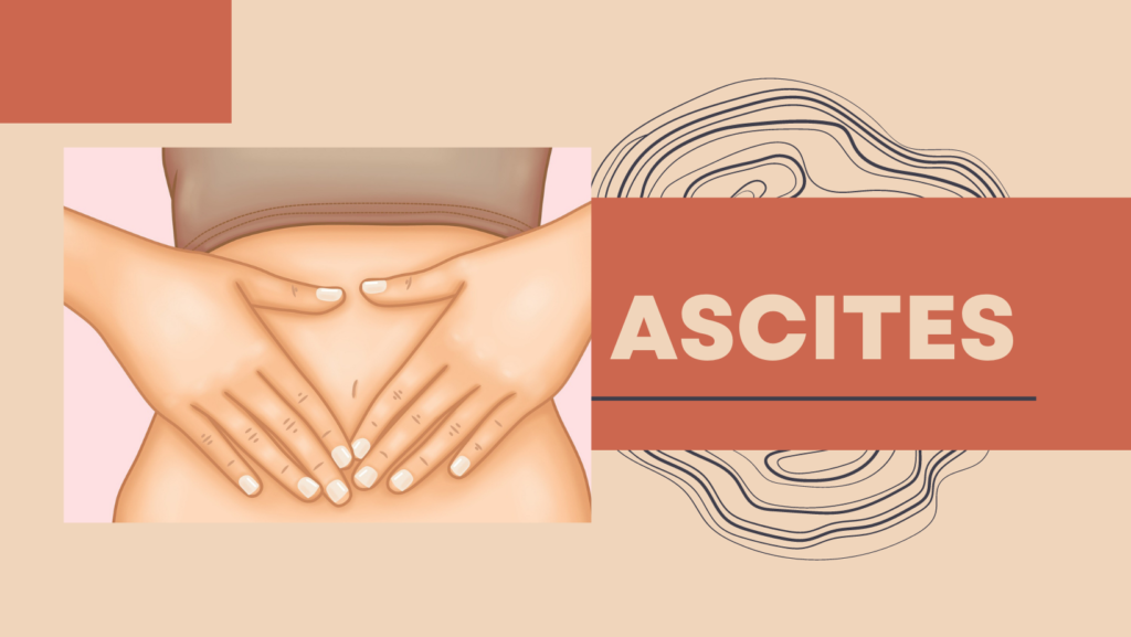 Ascites