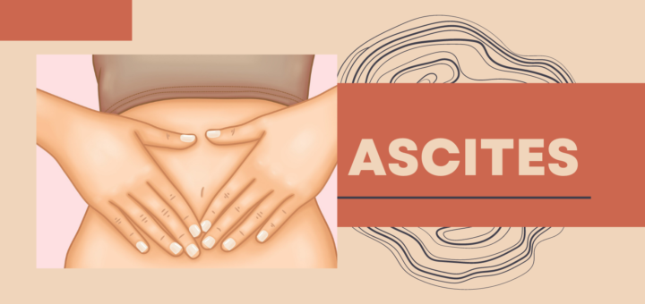 Ascites