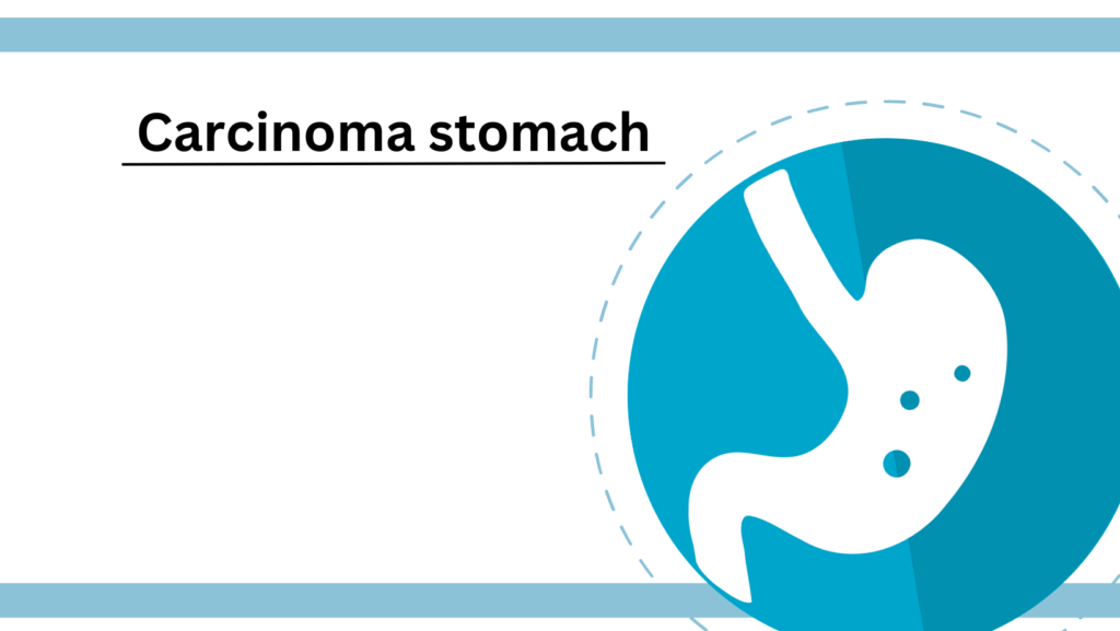 Carcinoma stomach