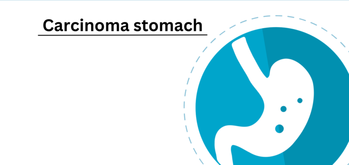 Carcinoma stomach