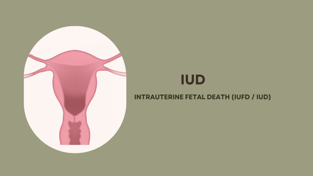 of Intrauterine Fetal death (IUFD / IUD)