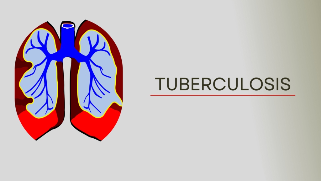 Tuberculosis