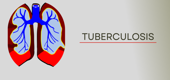 Tuberculosis