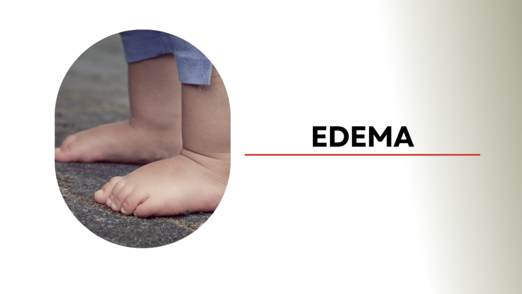 Edema