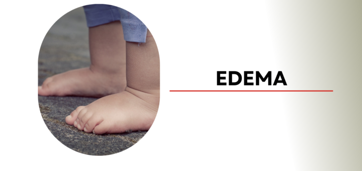 Edema