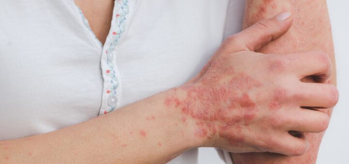 Skin Rash