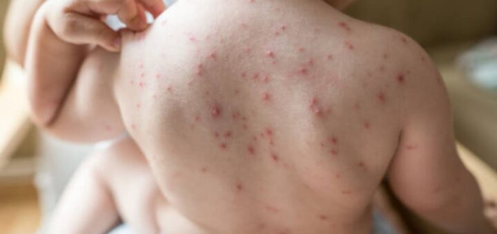 Chicken pox