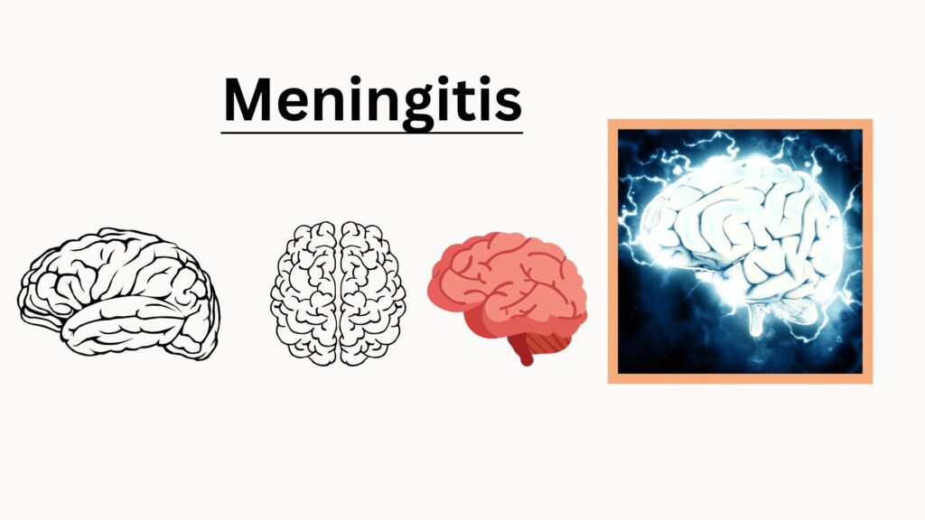 Meningitis