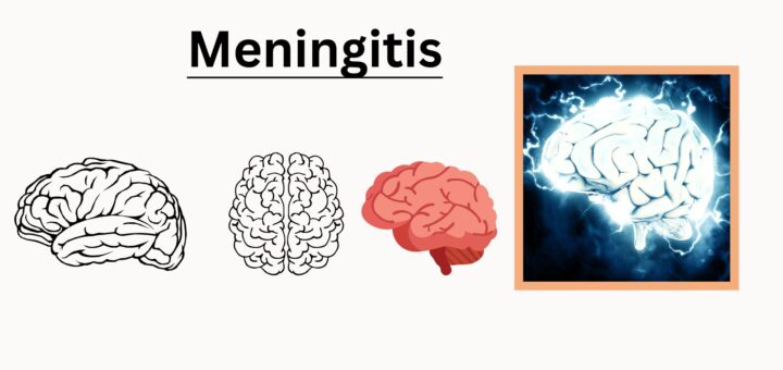 Meningitis