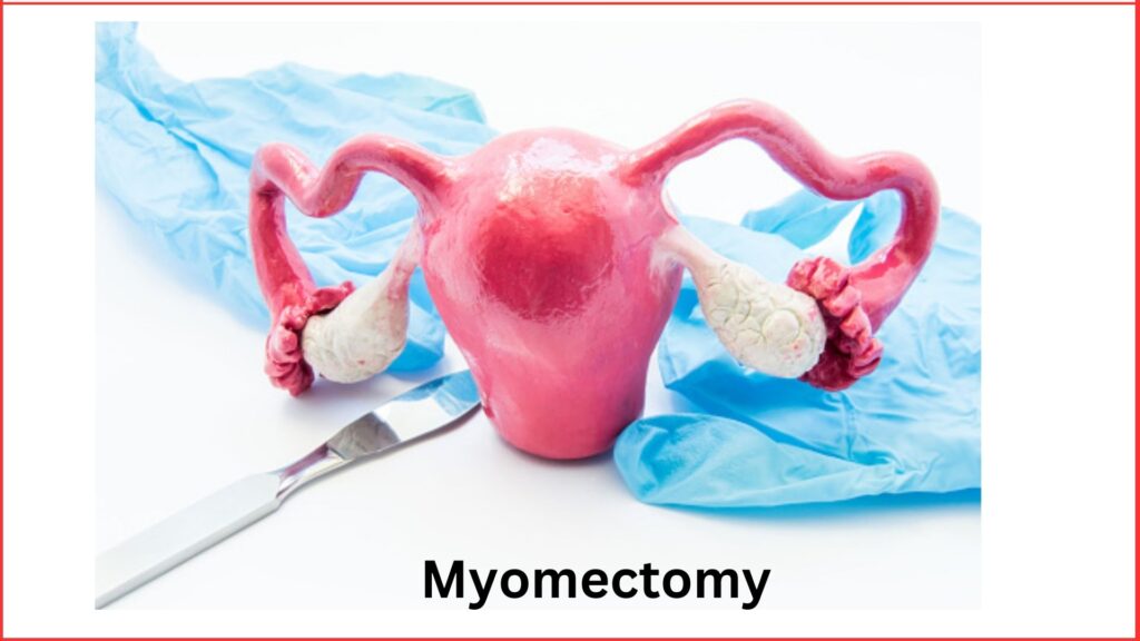 Myomectomy