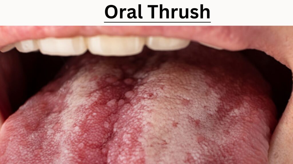 oral thrush