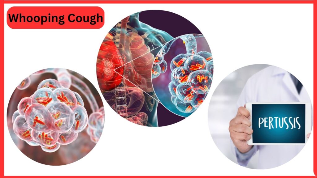 whooping cough