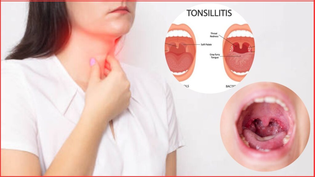 Acute tonsilitis