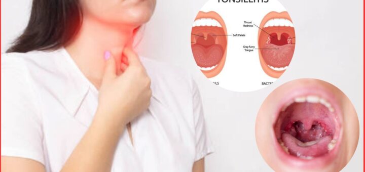 Acute tonsilitis