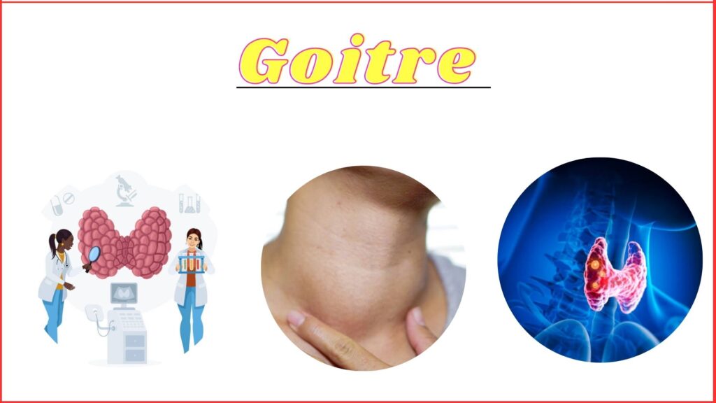 Goitre