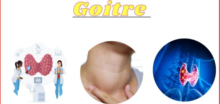 Goitre