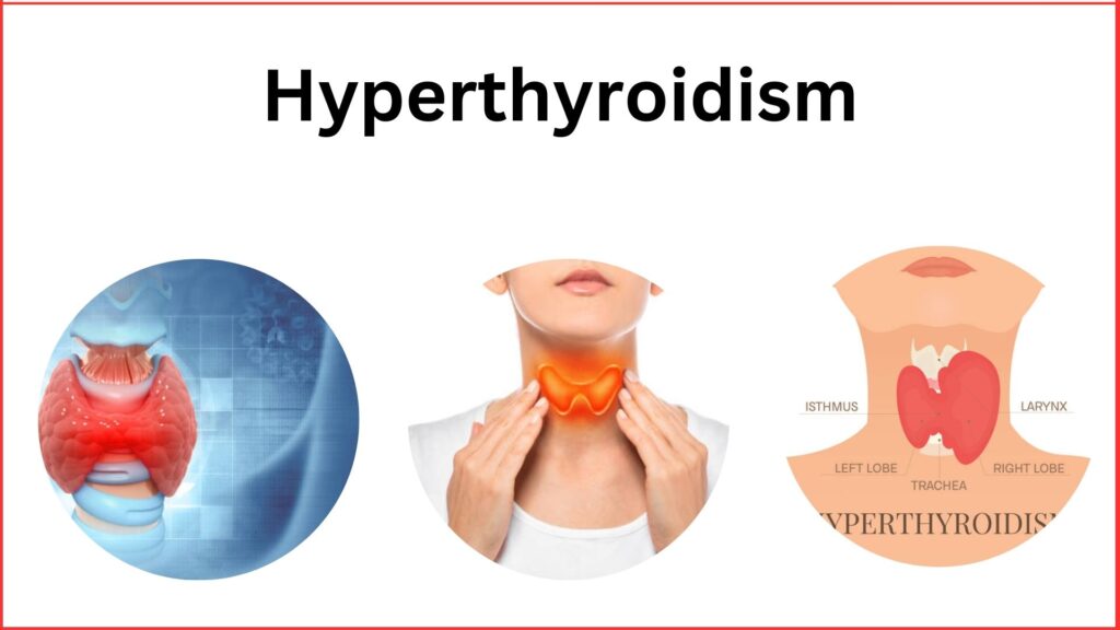 Hyperthyroidism