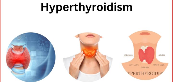 Hyperthyroidism