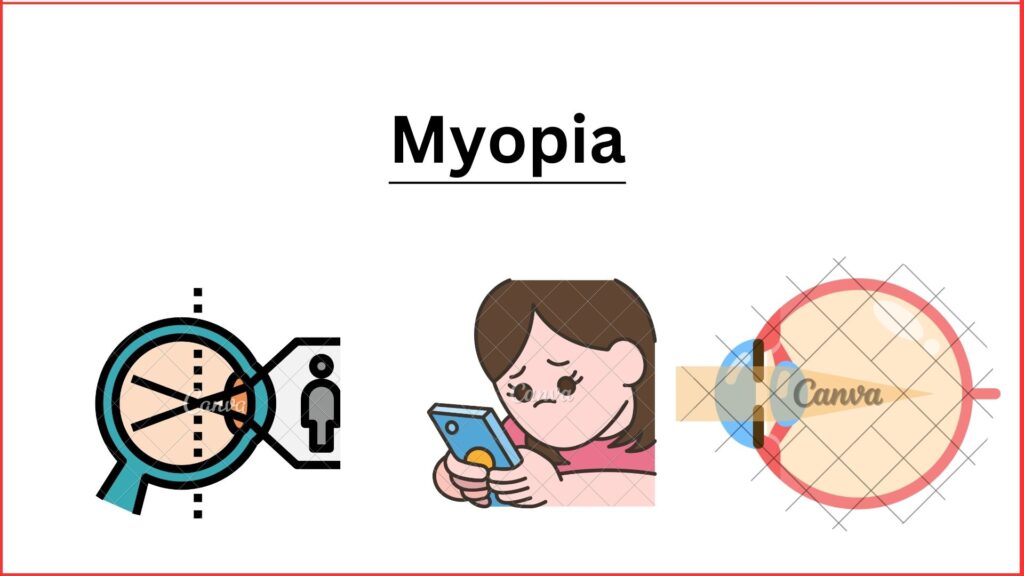 Myopia