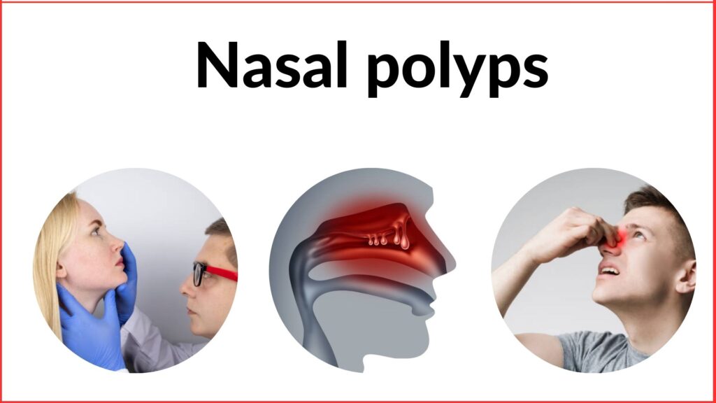 Nasal polyps