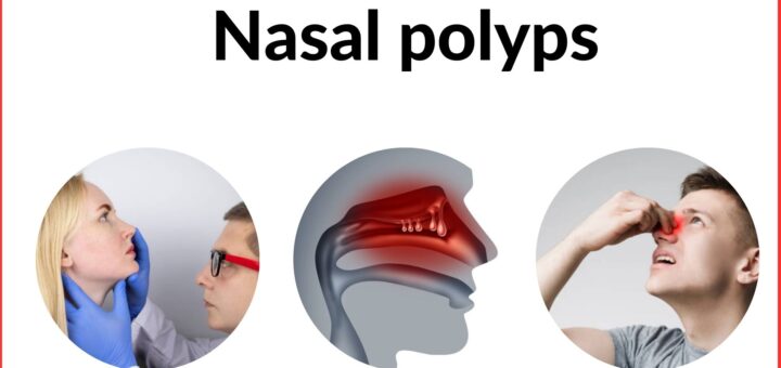 Nasal polyps