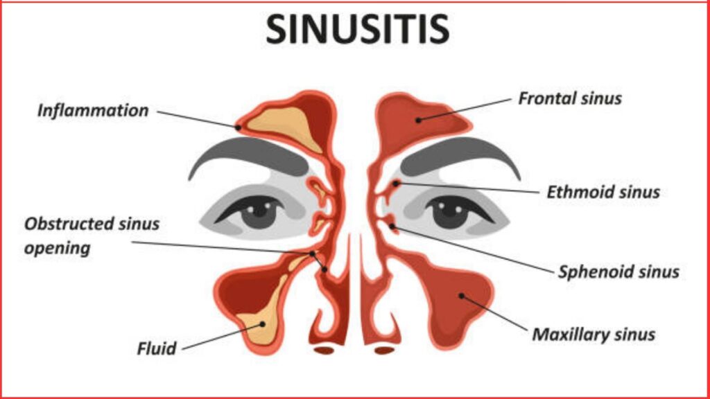 Sinusitis