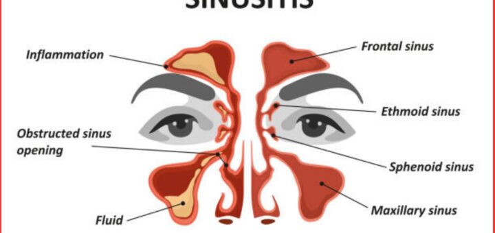 Sinusitis