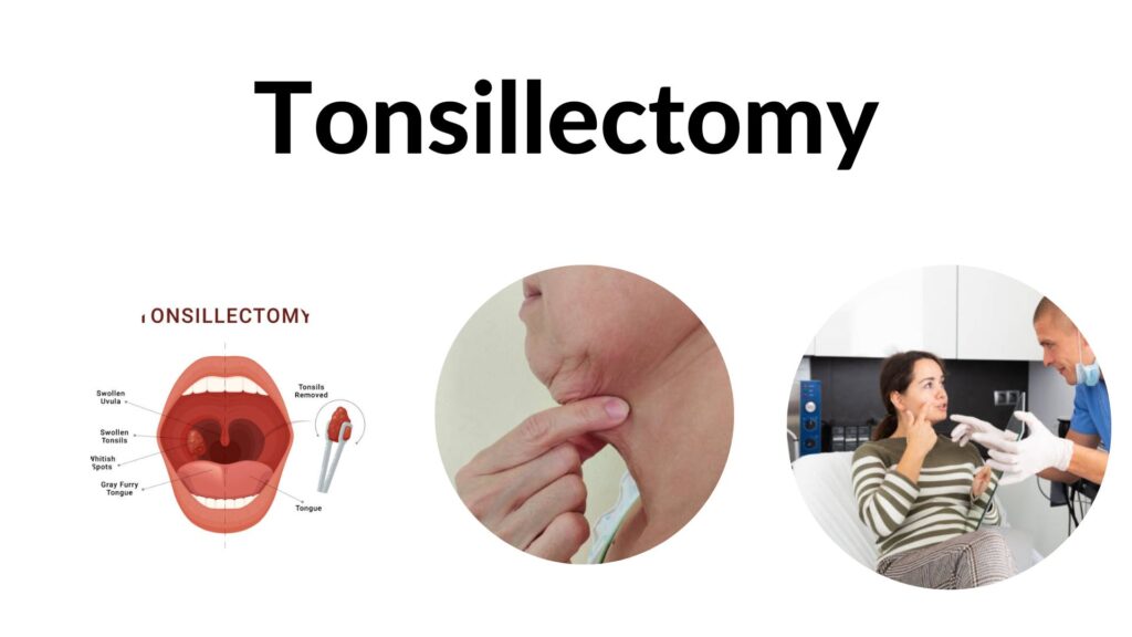 Tonsillectomy