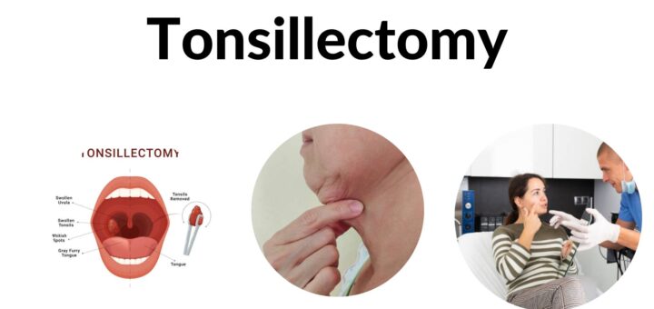 Tonsillectomy