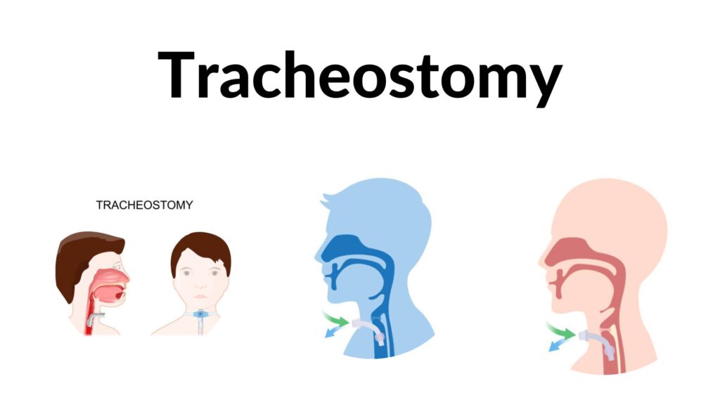 Tracheostomy