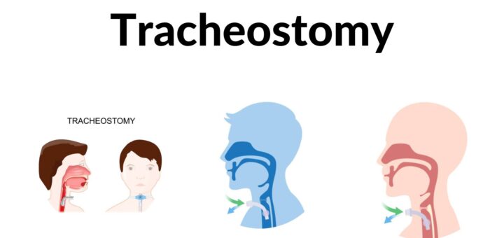 Tracheostomy